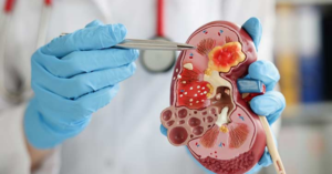 The Role of a Nephrologist