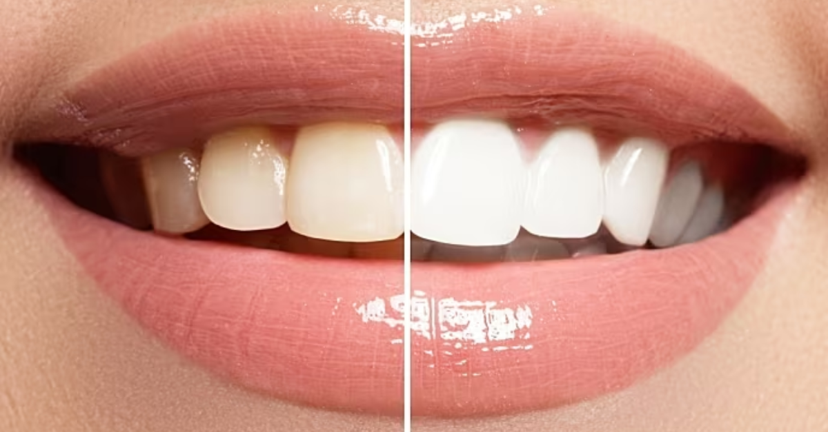 Teeth Whitening Options: Professional vs. At-Home Treatments