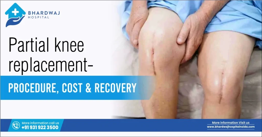 Partial Knee Replacement: Procedure, Cost & Recovery