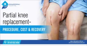 Partial Knee Replacement: Procedure, Cost & Recovery