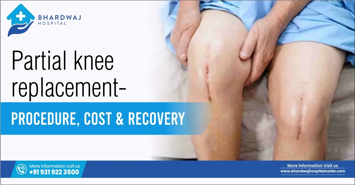 Partial Knee Replacement: Procedure, Cost & Recovery